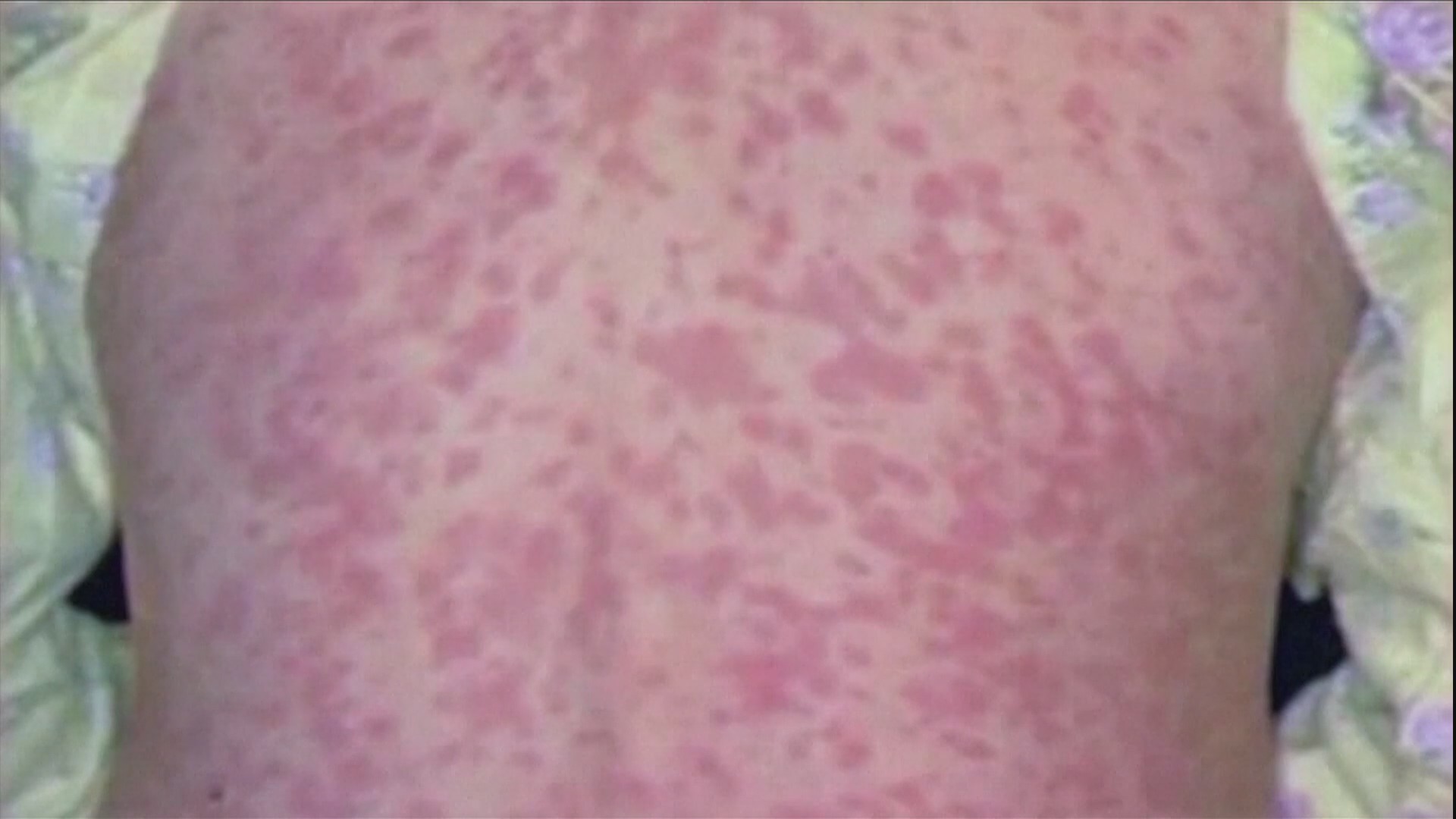 Lowcountry lawmaker files bill to make MMR vaccine mandatory for students