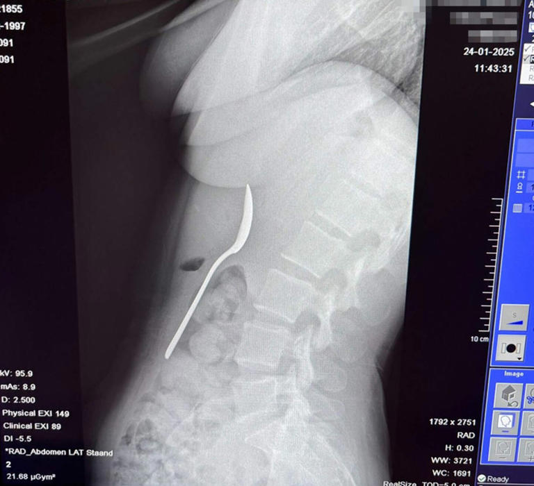 Woman could feel 17cm spoon 'moving inside of her' after accidentally ...