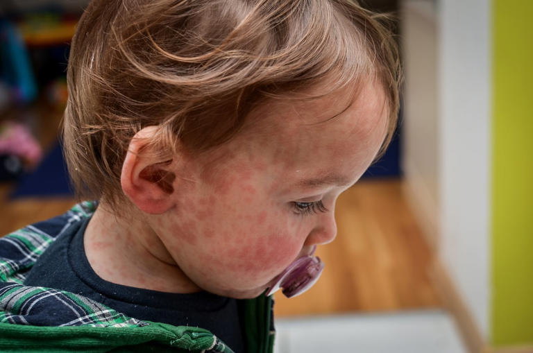 Manitoba reports 45 new measles cases, continues to make up most of ...