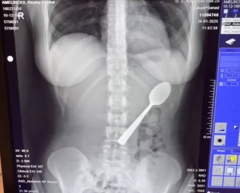 Vô tình nuốt phải thìa dài 17 cm khi đang ăn sữa chua