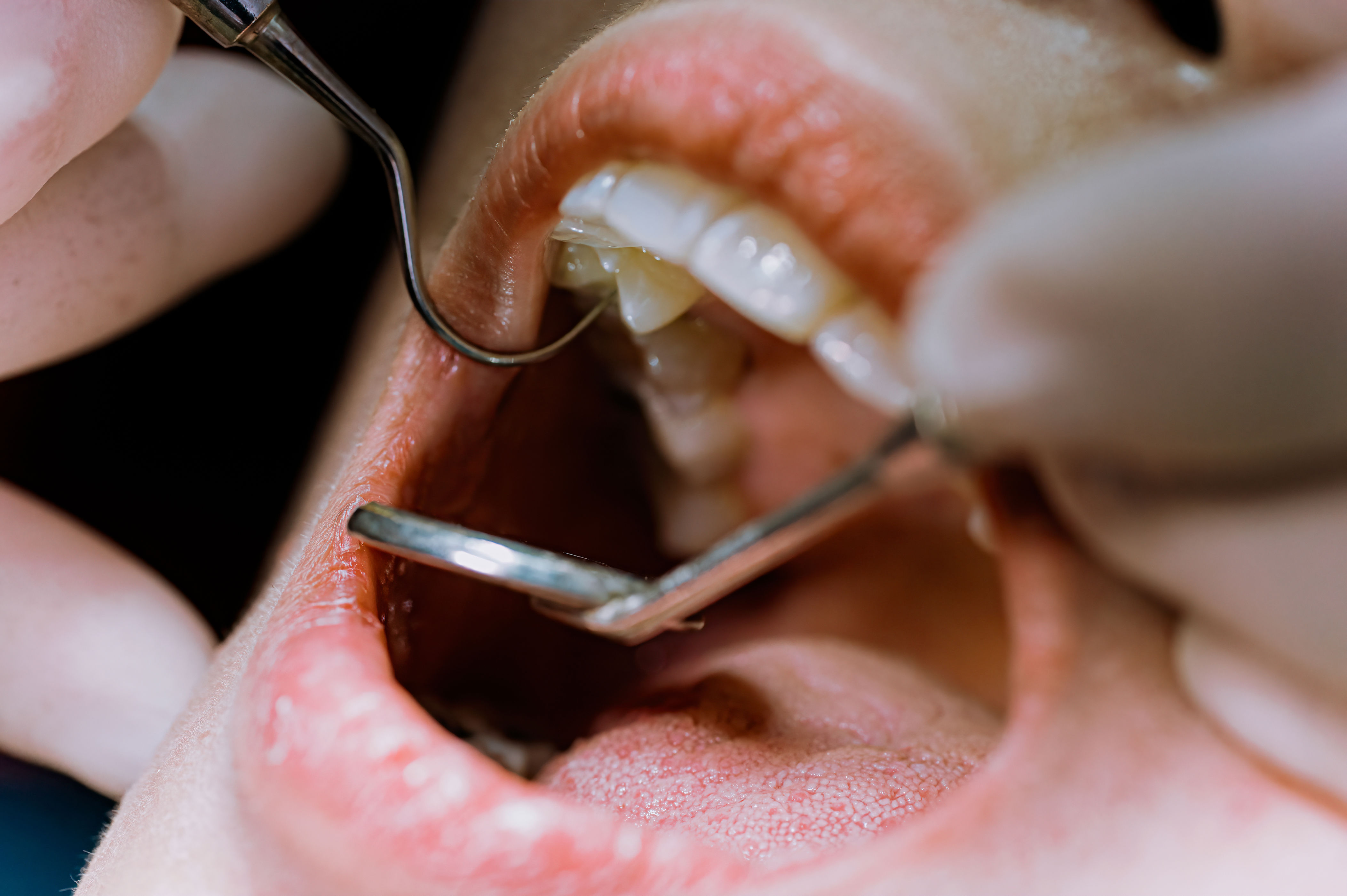 Close-up of a dental examination, showing a mouth open with dental tools checking teeth and gums