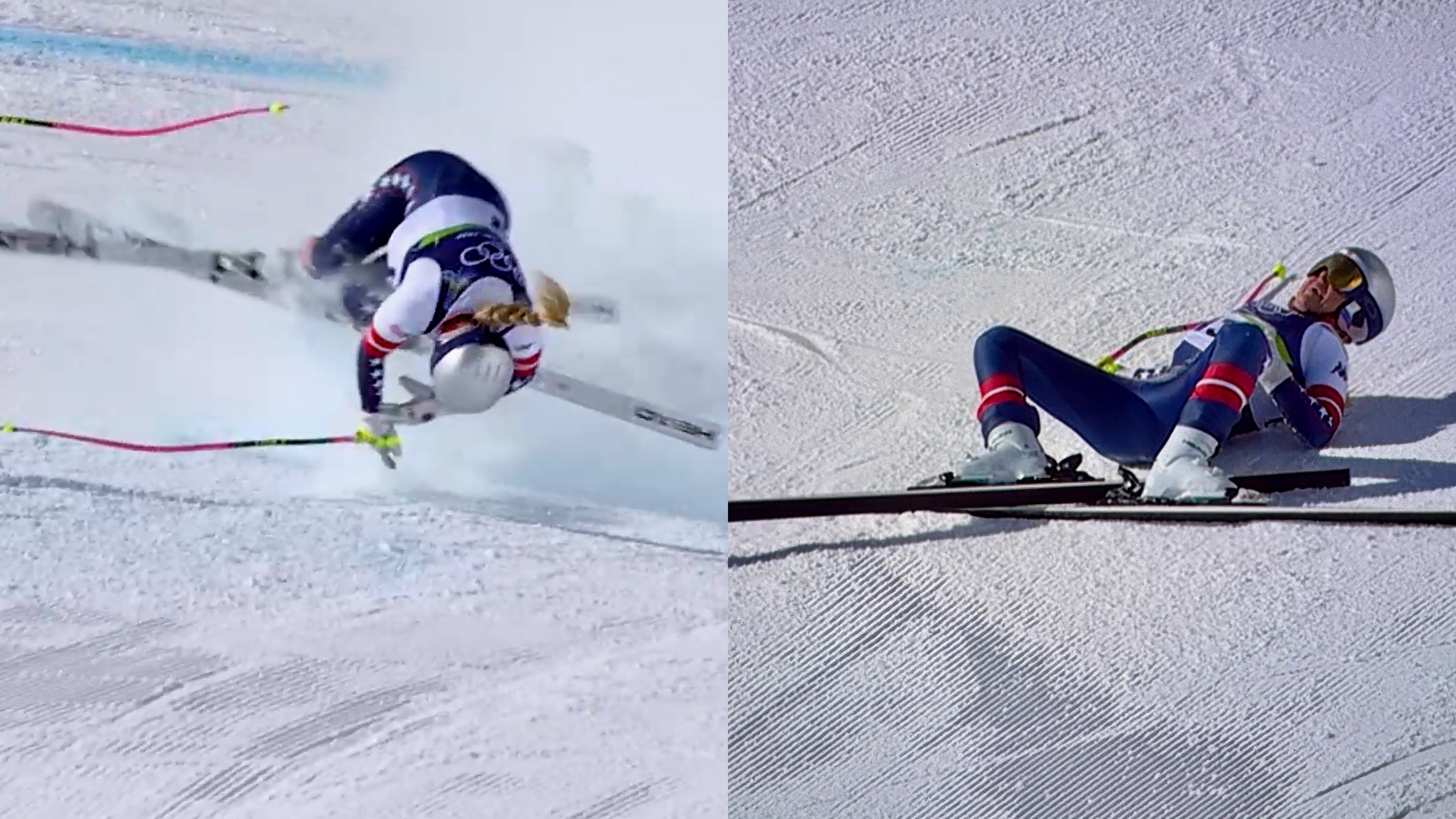 Skiing legend Lindsey Vonn needed second surgery after horrific leg injury