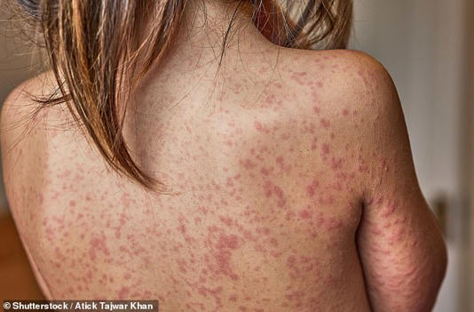 South Carolina's outbreak of measles, which causes the distinctive rash pictured above, has surpassed a massive surge seen in Texas last year (stock image)