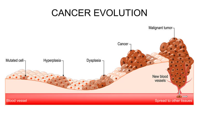 Heavy drinking over time linked to colorectal cancer risk