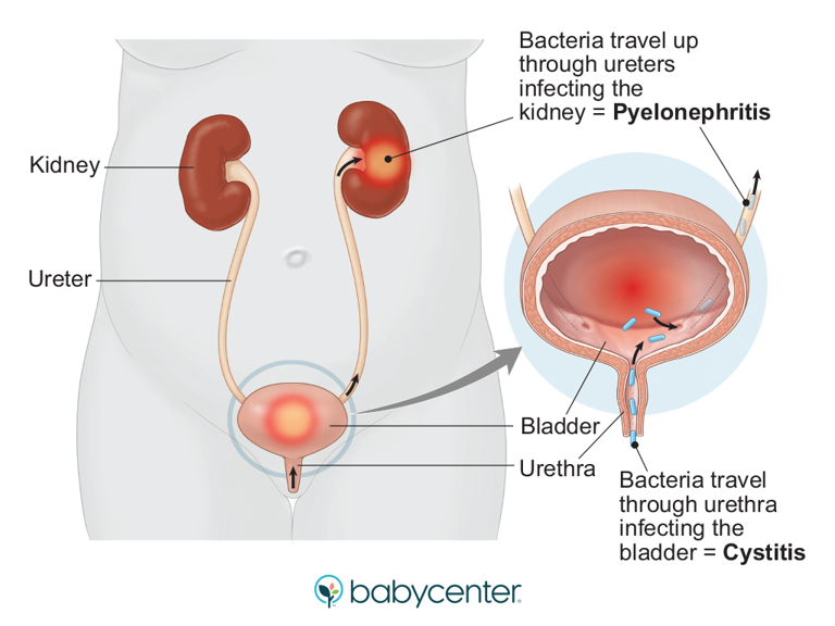Pregnancy makes UTIs more likely. Here's how to spot one and feel ...