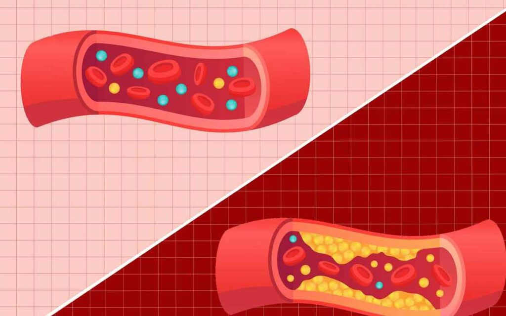 HDL and LDL | హెచ్‌డీఎల్, ఎల్‌డీఎల్ అంటే ఏమిటి? మ‌న శ‌రీరంలో హెచ్‌డీఎల్ ...