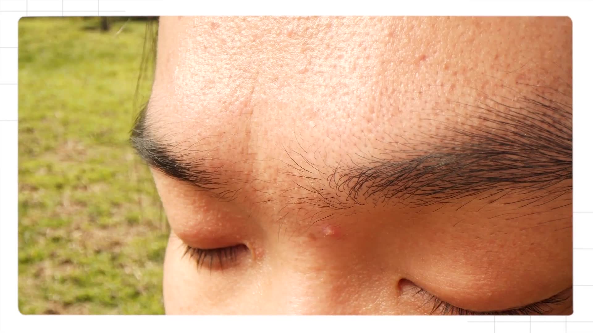 Understanding the different types of acne and triggers that cause breakouts