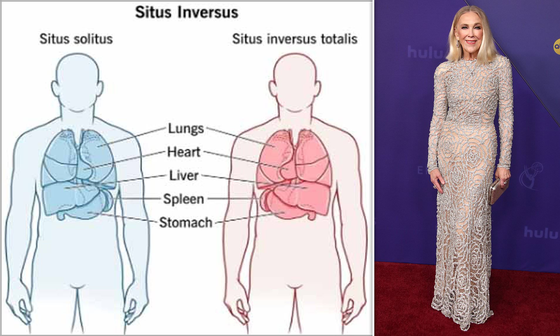 How to tell if YOU have situs inversus like Home Alone star Catherine O ...