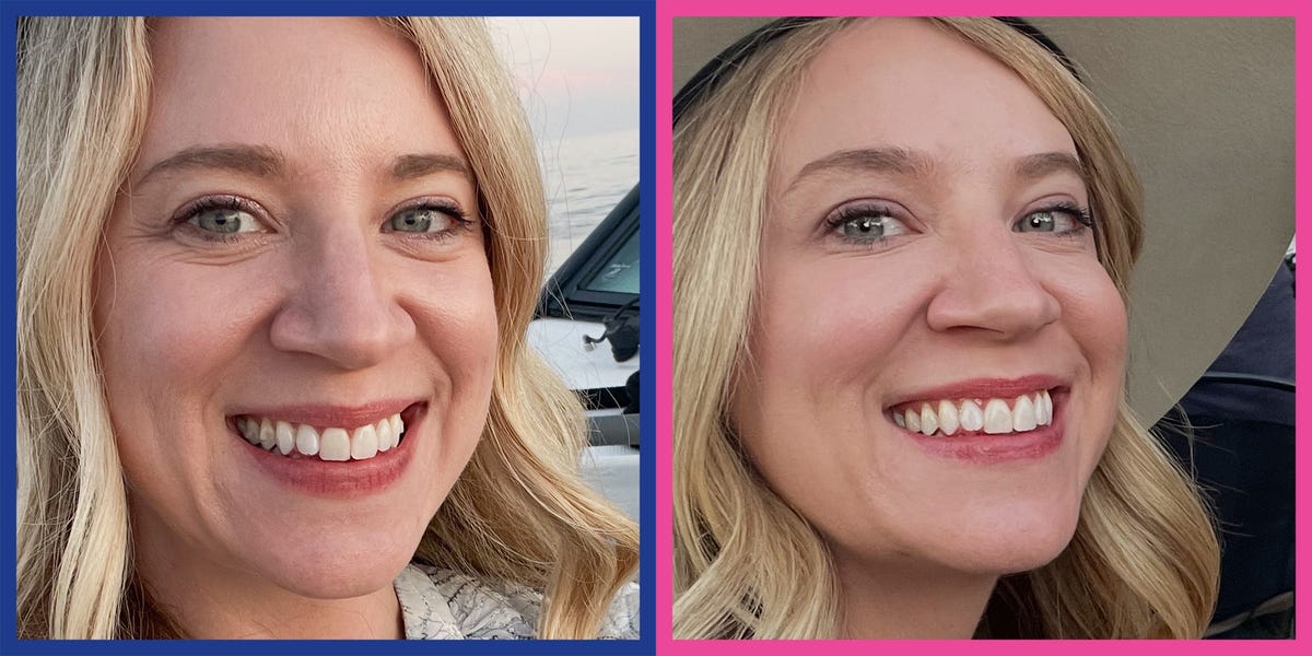I'm 40 and had my own blood injected under my eyes to fade wrinkles and ...