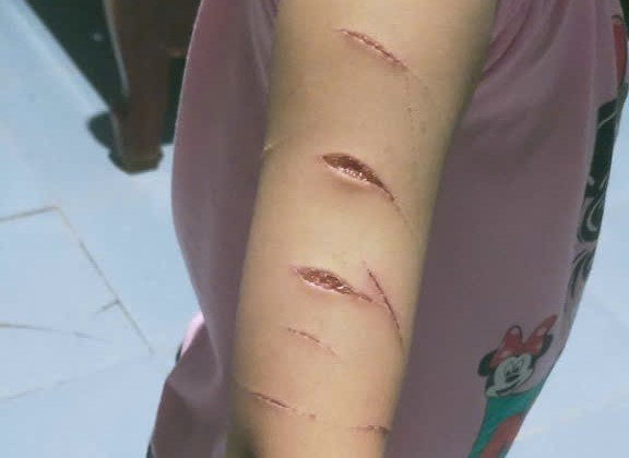 Vụ nữ sinh lớp 5 ở Cà Mau bị rạch tay: Sở Y tế đề xuất biện pháp xử lý