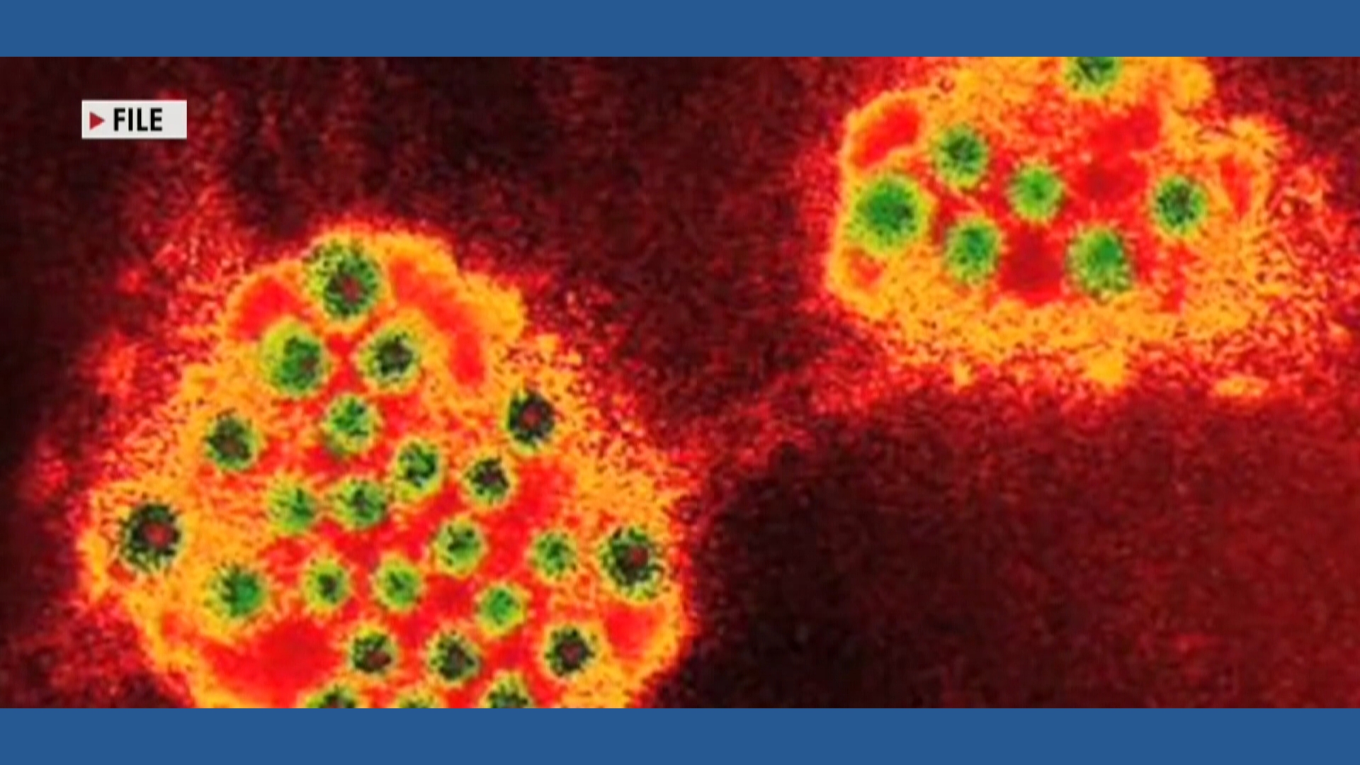 What to know about norovirus, or the stomach bug