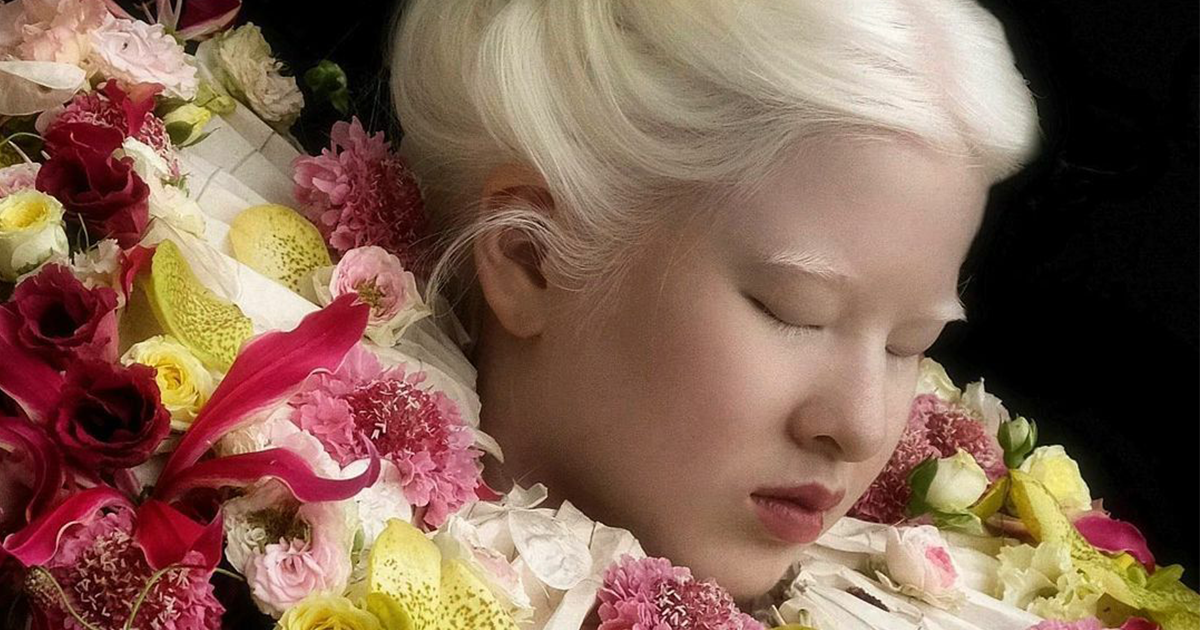 Abandoned as a baby due to albinism, Xueli grew up to become a Vogue ...