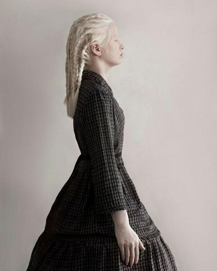 Abandoned as a baby due to albinism, Xueli grew up to become a Vogue ...