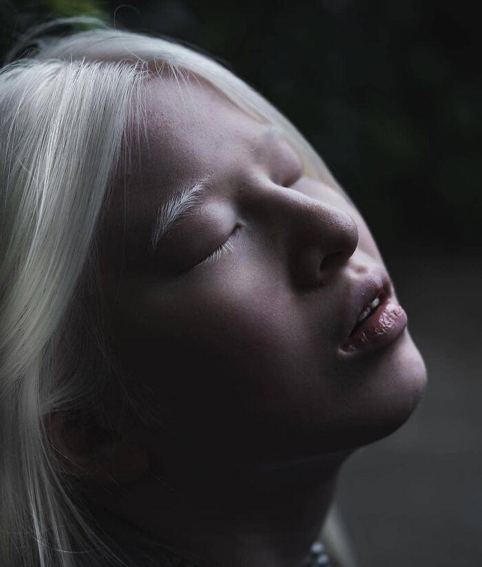 Abandoned as a baby due to albinism, Xueli grew up to become a Vogue ...
