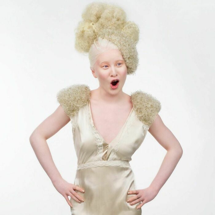 Abandoned as a baby due to albinism, Xueli grew up to become a Vogue ...