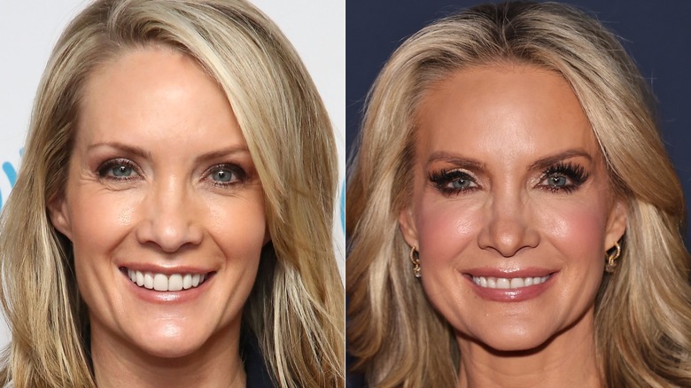 Featured - Dana Perino Plastic Surgery