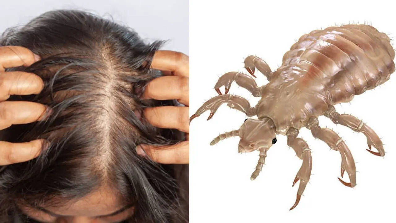 Can head lice kill? How a severe infestation led to an Odisha girl’s death
