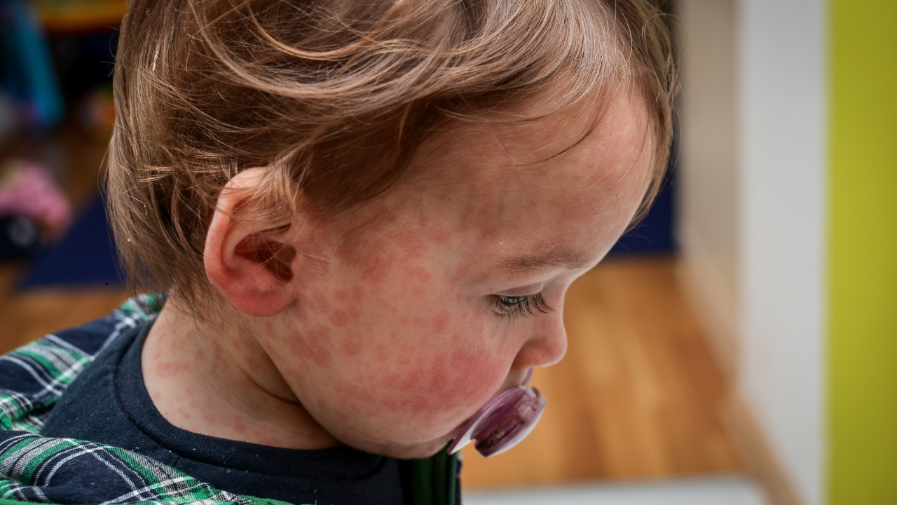 Measles cases cross 14,000 in Mongolia, mostly among partially ...