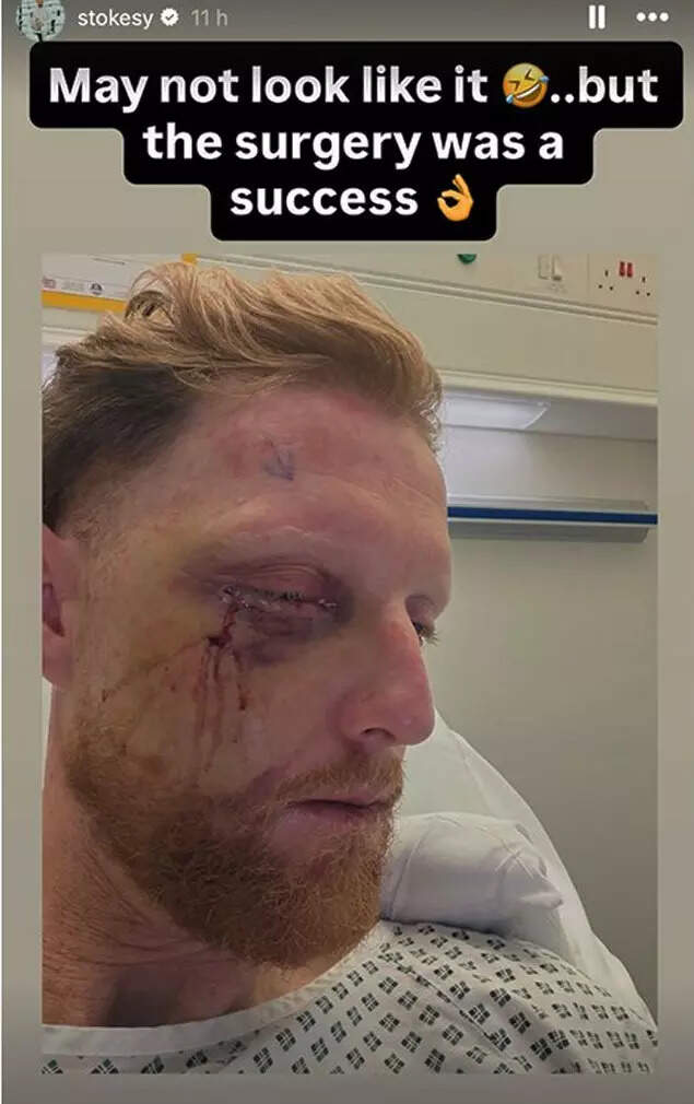 AA1W6LLM Ben Stokes Gets Facial Surgery After Unusual Net Incident, England Captain Shares Photo