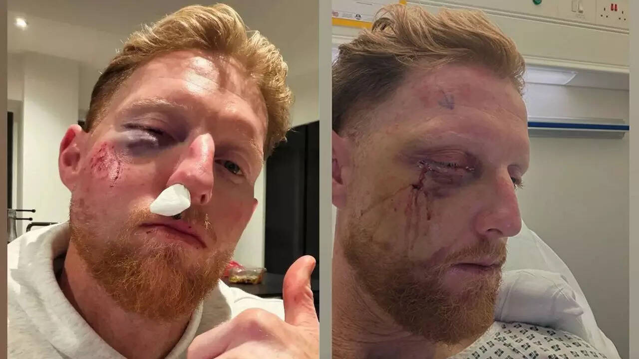 Ben Stokes undergoes facial surgery after freak nets blow, England captain shares pic<br><br>