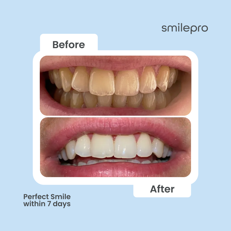 Get an at-home summer glow-up with 50% off an LED teeth whitening kit