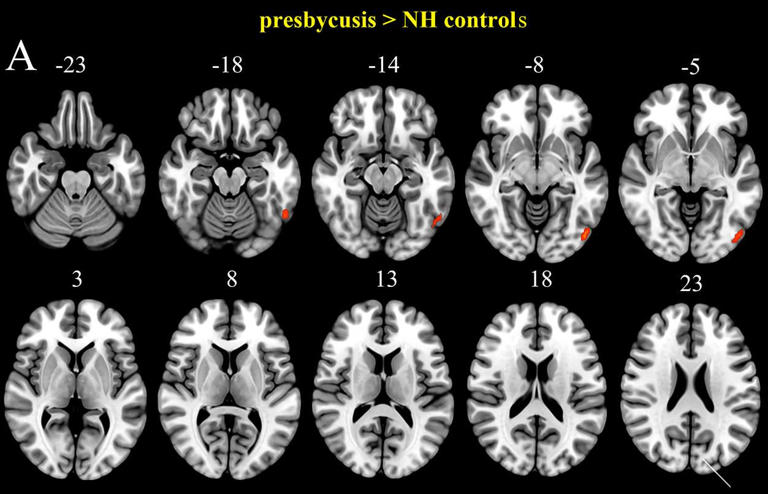 Scientists reveal a link between hearing loss and cognitive decline
