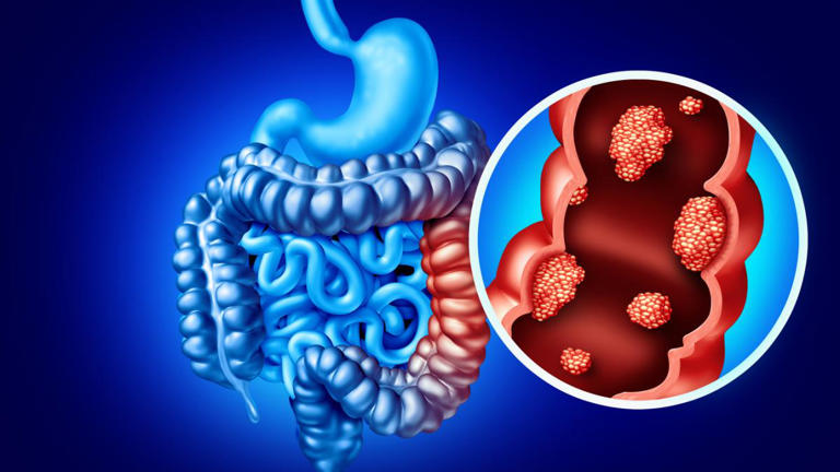 Identifican un factor clave del cáncer de colon y recto en menores de ...