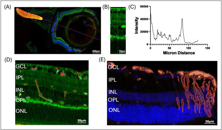 Eyes may be a window into early Alzheimer's detection