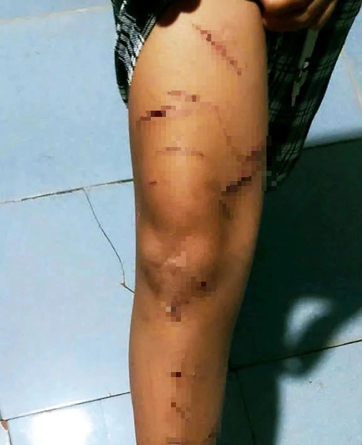 Vụ bé gái bị rạch nhiều vết trên người: Giao 'thủ phạm' cho gia đình, nhà trường quản lý, giáo dục