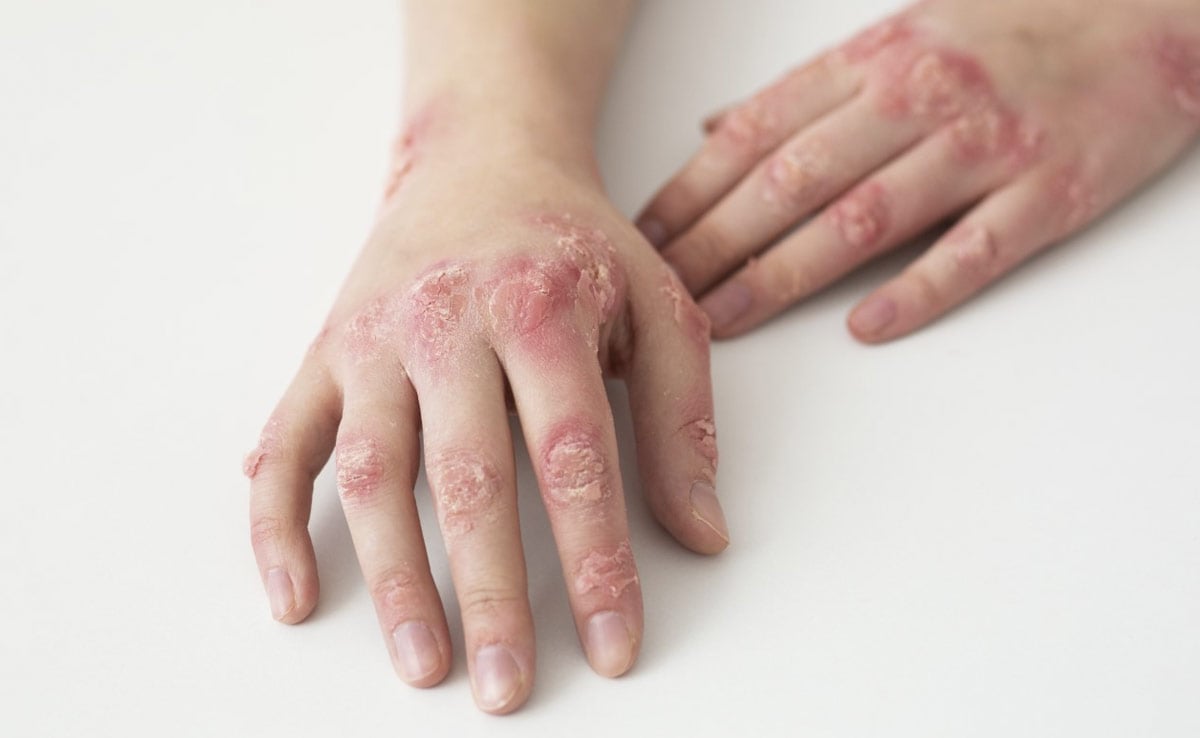 Ever heard of jock itch or tinea? Why that rash might be more than just ...