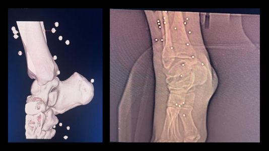 Shotgun pellets in the foot area of a patient seen in CT scan and X-ray images (Supplied)