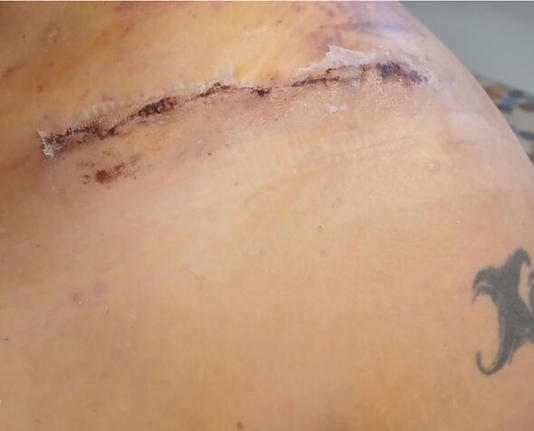 A deep gash on Mr Antonetty's shoulder