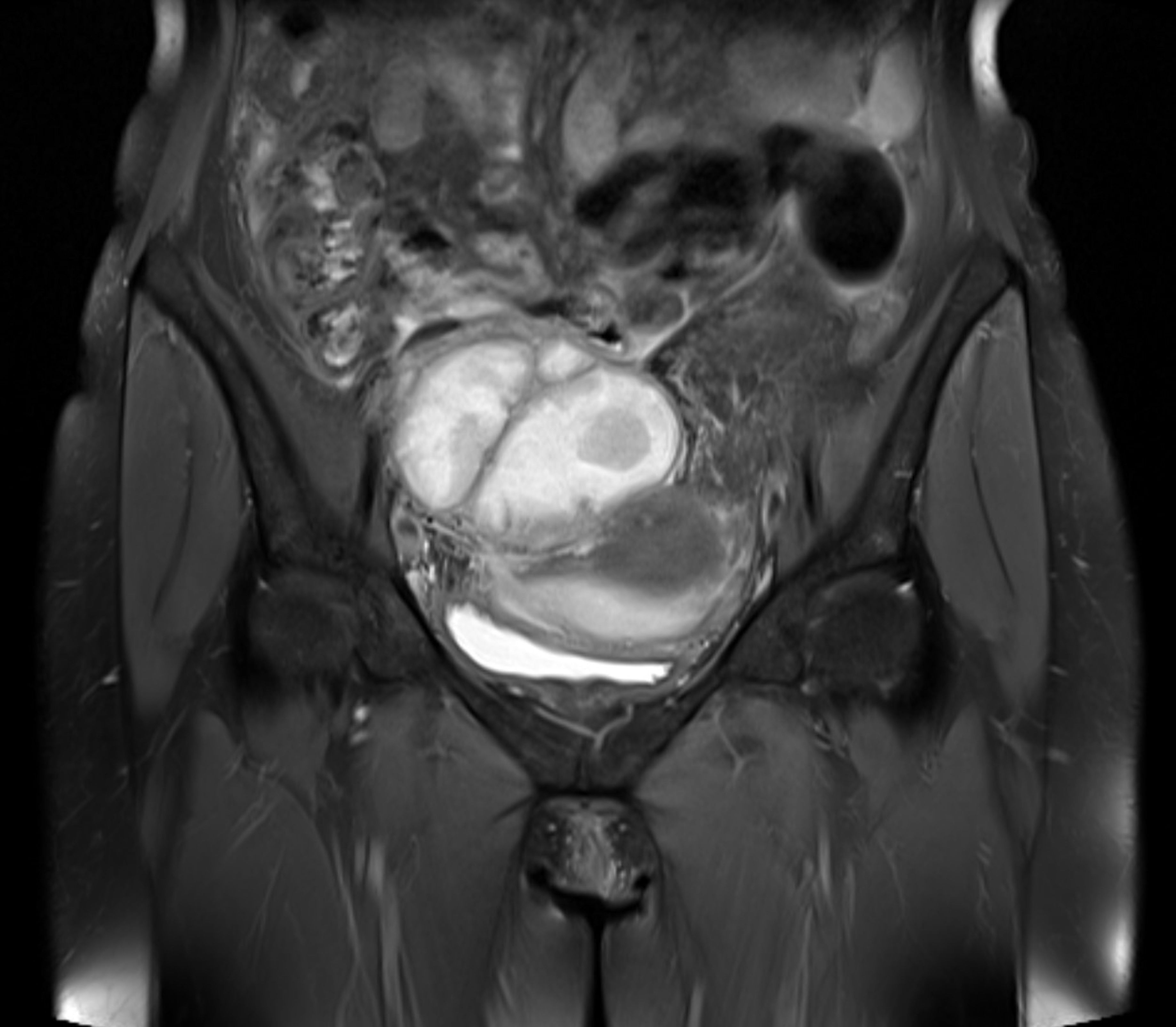 Medical scan showing a cross-sectional view of the pelvis, highlighting various internal organs