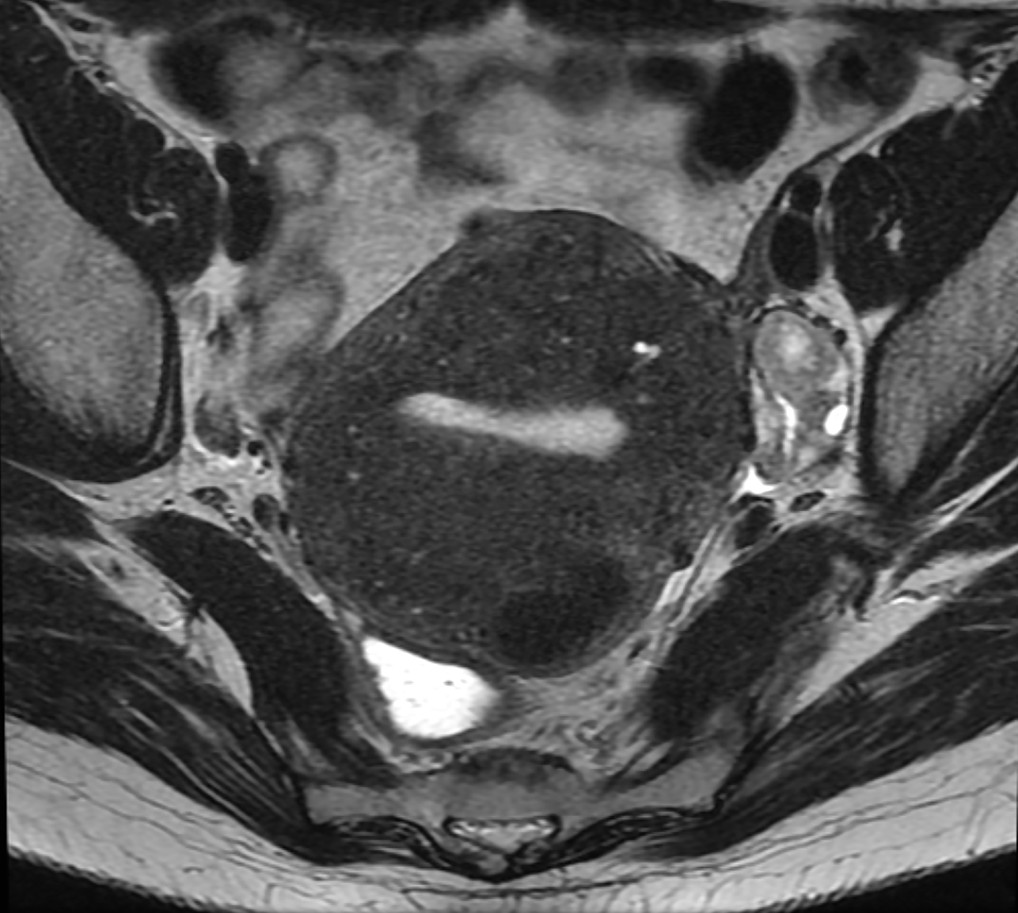 Medical MRI scan showing a cross-section view of internal organs in the pelvic area