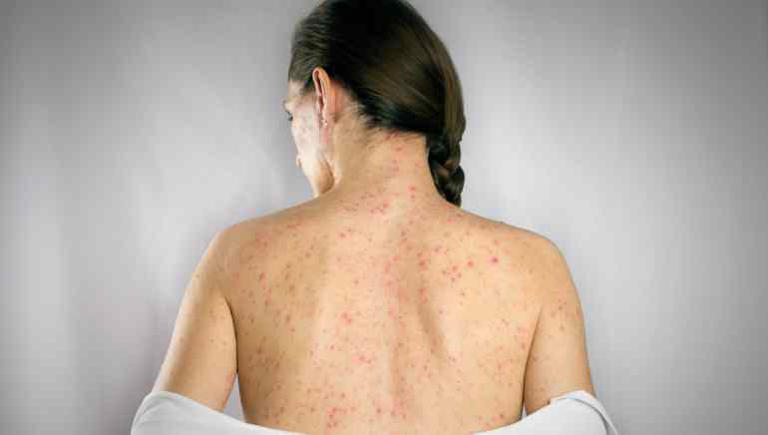 Shingles Action Week 2026: Why seniors with chronic illnesses are at ...