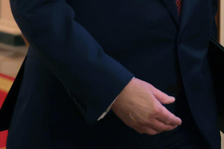 Trump’s hand caked in makeup as he covers bruise for mining event
