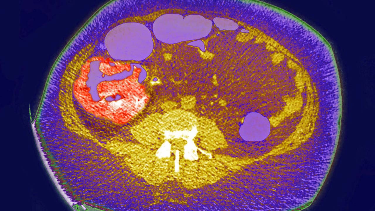 Bay Area doctors explain how to reduce colon cancer risk after James ...