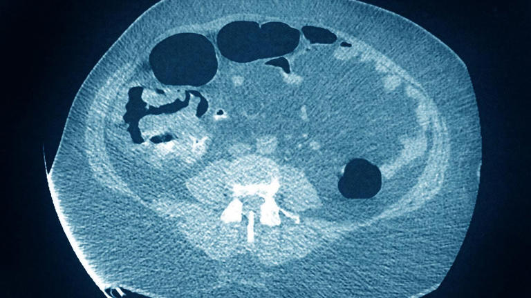 Bay Area doctors explain how to reduce colon cancer risk after James ...