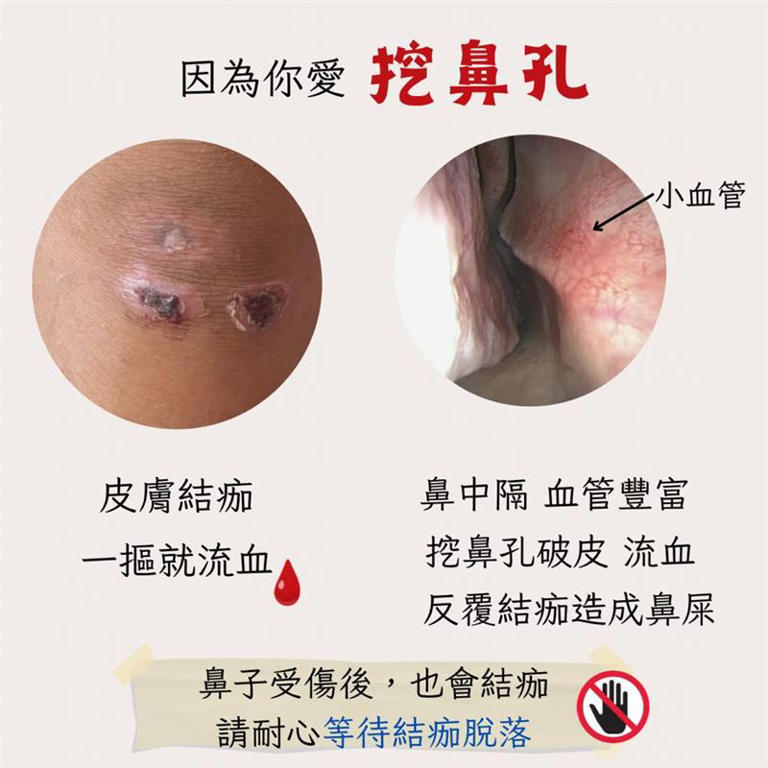 「鼻屎暴增」竟是罹癌徵兆! 3原因鼻屎變多…符合「2症狀」盡速就醫