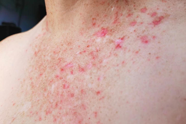 NHS says ibuprofen could be trigger of common itchy skin condition