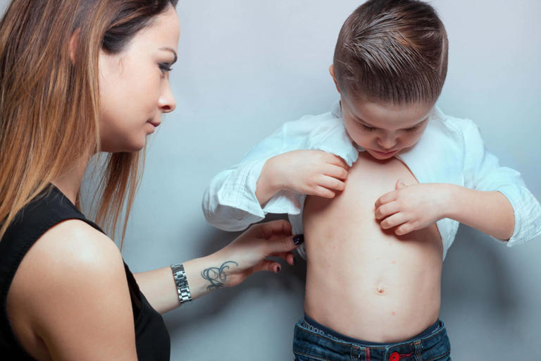 6 subtle warning signs of measles in children – and how to prevent it