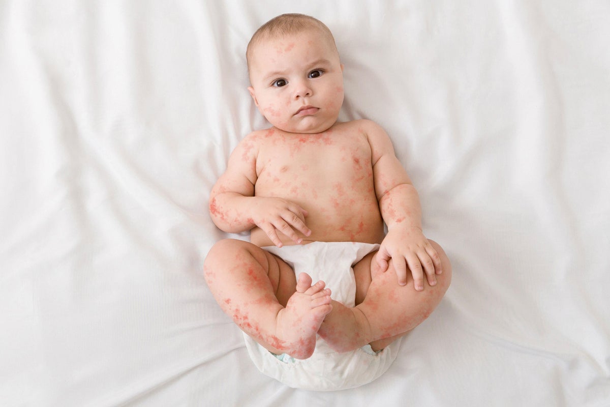 Six subtle symptoms of measles in children and how to get the vaccine<br><br>