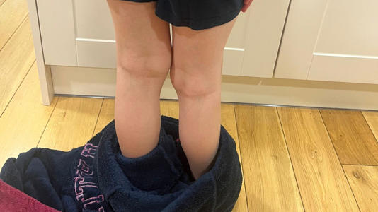 Alfie Phillips's knees before his leg-lengthening surgery at Alder Hay hospital. Pic: PA