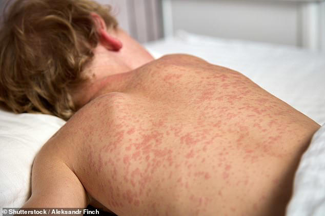 Thousands of travelers at major US airport exposed to measles as ...