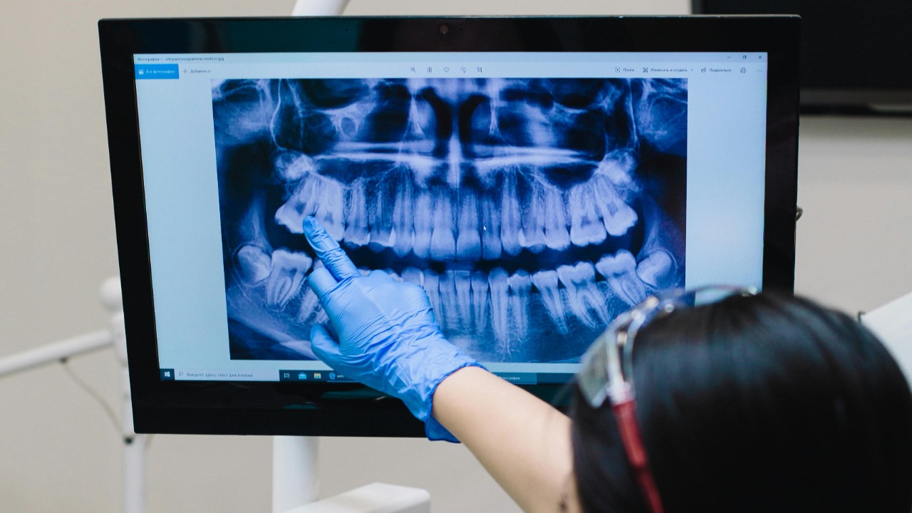 New drug could unlock humans’ hidden third set of teeth