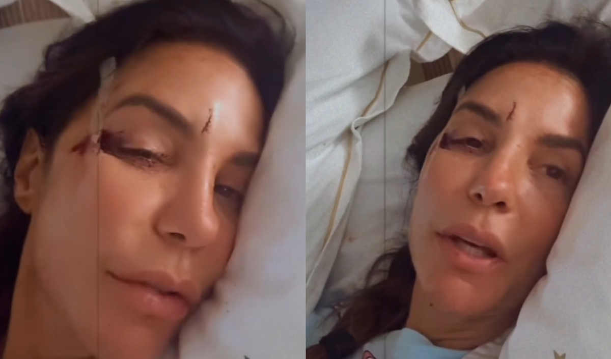 Ivete Sangalo mostra rosto com ferimentos ap&oacute;s desmaiar em casa; cantora est&aacute; internada em Salvador