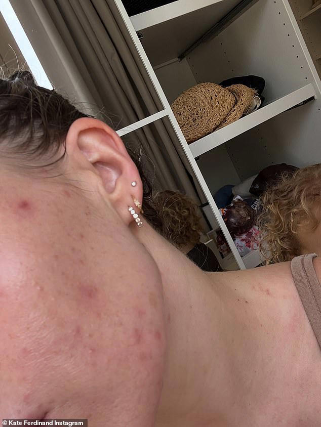 Kate Ferdinand says living in Dubai is giving her skin breakouts after ...