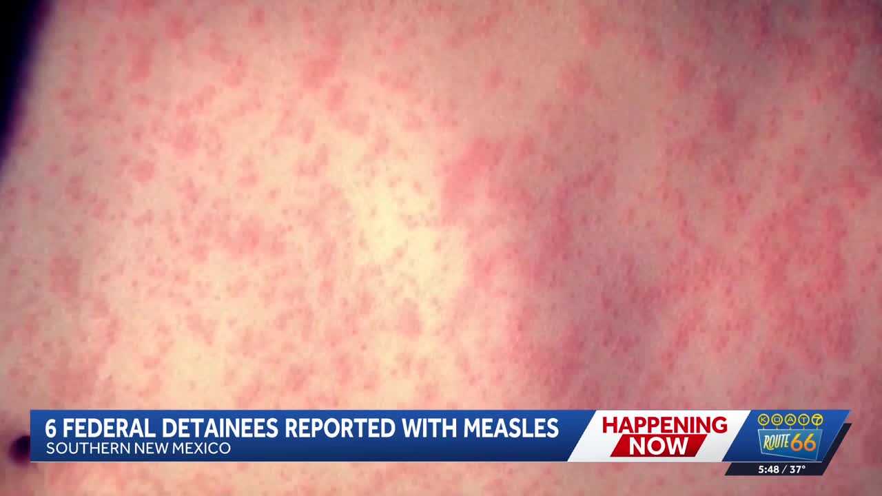 Measles cases reported among federal detainees in New Mexico