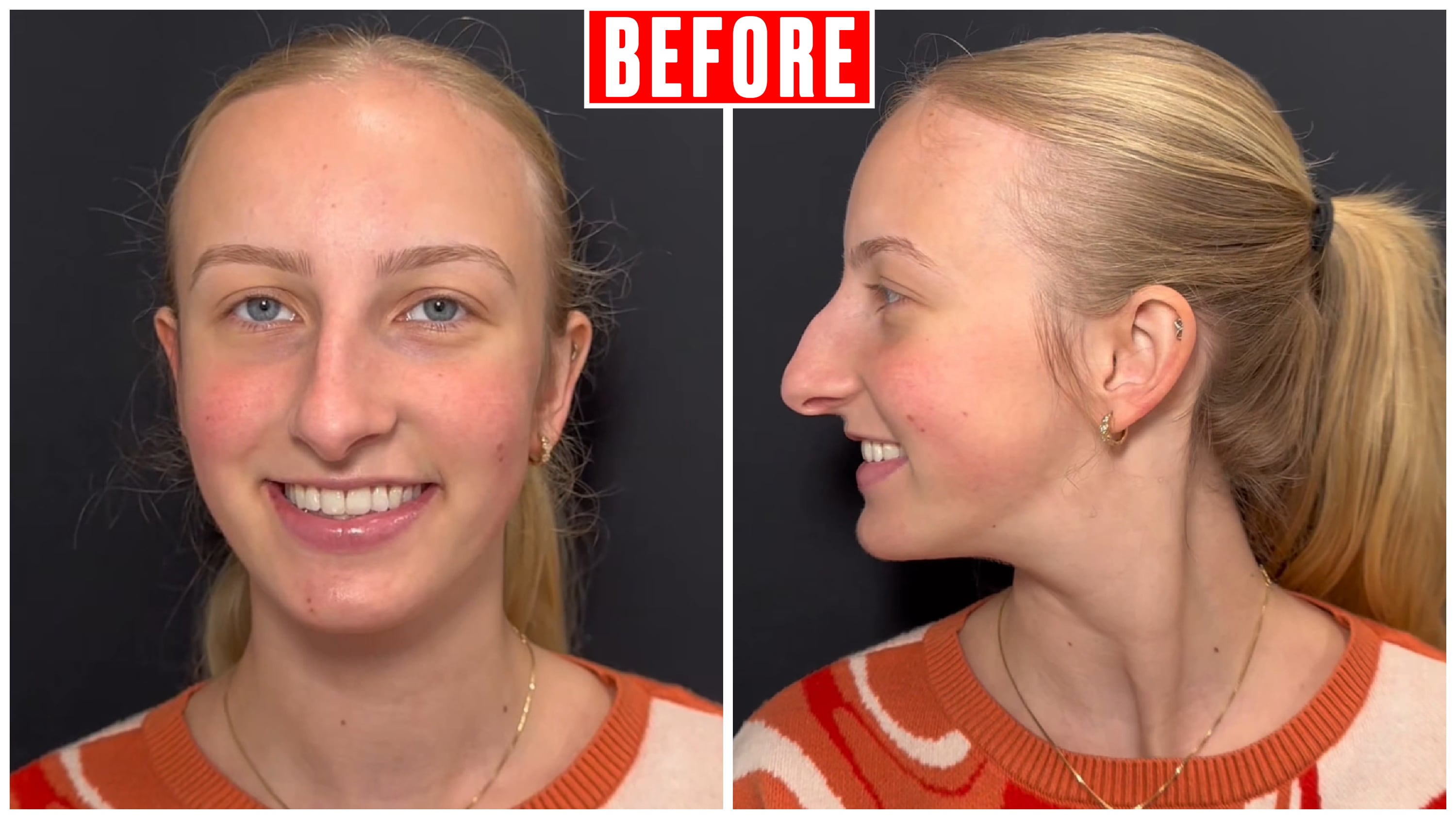 Woman’s $25K nose job shows the power of a subtle transformation