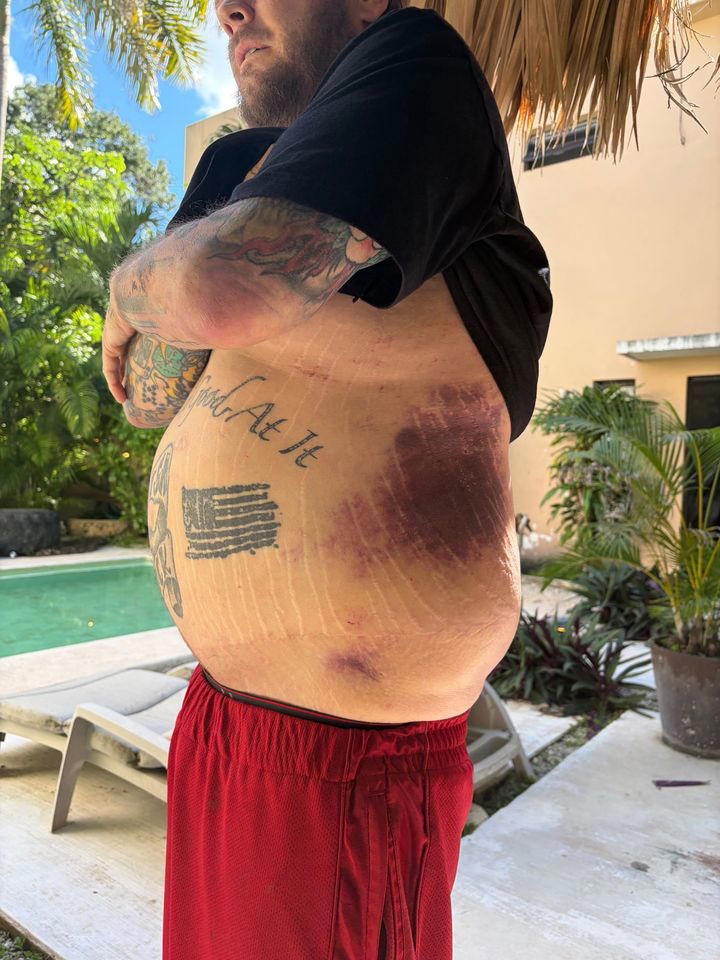 Pawn Stars' Corey Harrison's motorcycle injury Credit: gofundme